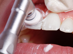 院の予防歯科メニュー